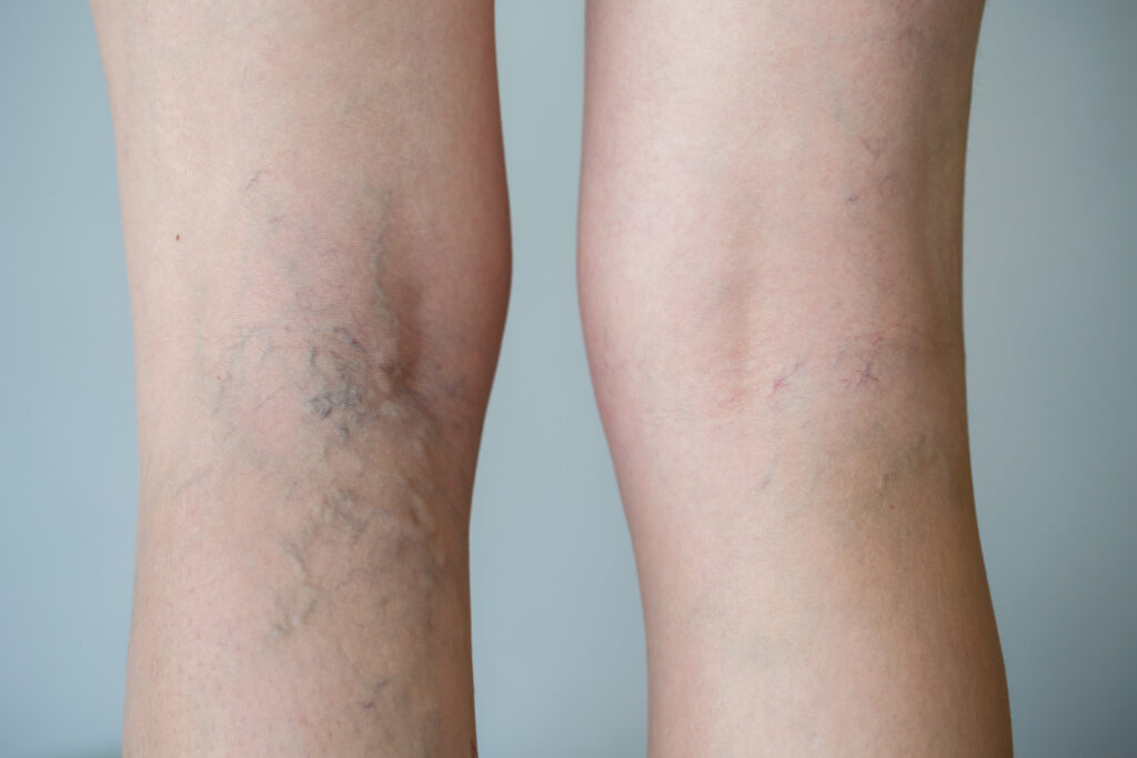 Synliga vener på benen – det kan vara både åderbråck och ådernät
