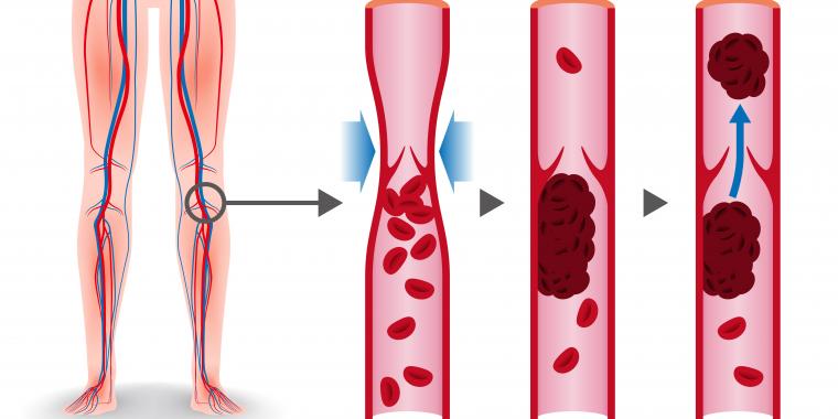 blodpropp i benet grafik