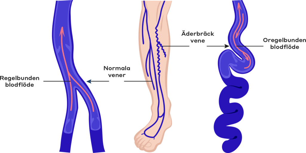 normala vener vs åderbråck vener