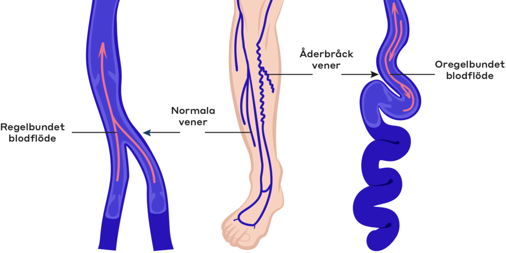 normala vener vs åderbråck vener